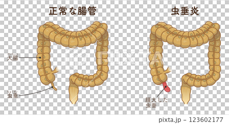 appendicitis illustration appendicitis illustration appendicitis illustration appendicitis illustration 123602177