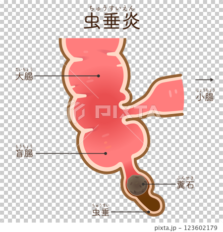 appendicitis illustration appendicitis illustration appendicitis illustration appendicitis illustration 123602179