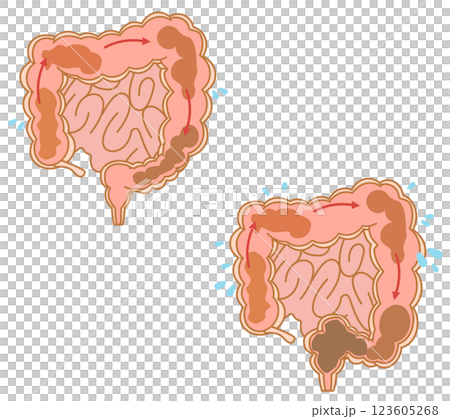 Normal peristalsis and constipated peristalsis of the large intestine Normal peristalsis and constipated peristalsis of the large intestine 123605268