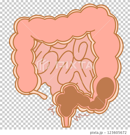 Illustration of rectal constipation 123605672