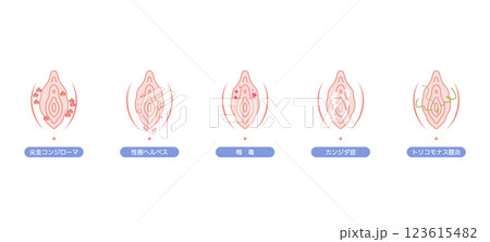 女性外性器の病気 女性外性器の病気 123615482