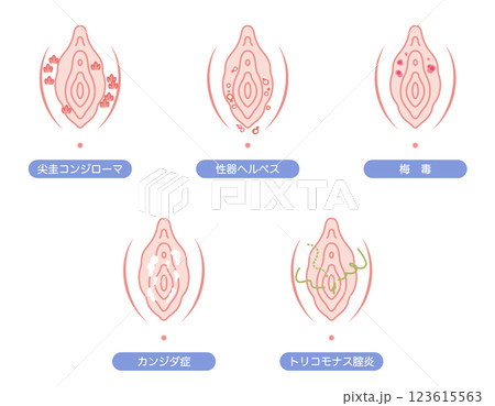 女性外性器の病気 123615563