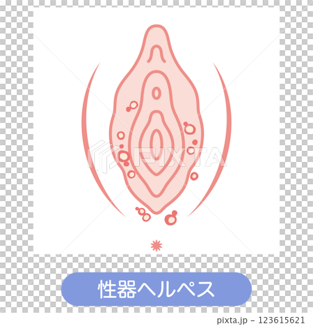 Diseases of the female external genitalia: Genital herpes Diseases of the female external genitalia: Genital herpes 123615621