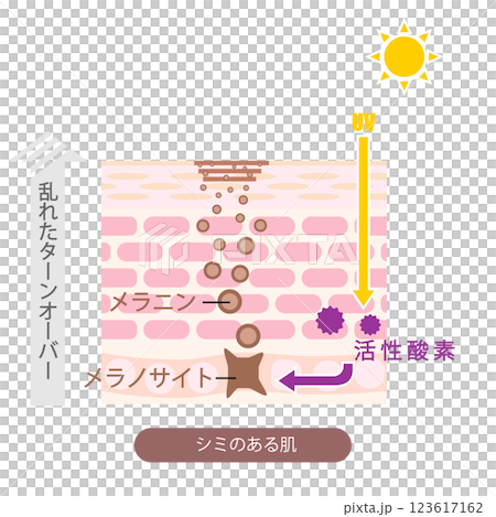 皮膚橫切面上的瑕疵圖示 皮膚橫切面上的瑕疵圖示 123617162