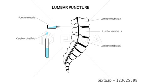 Lumbar puncture spinal tap Lumbar puncture spinal tap 123625399
