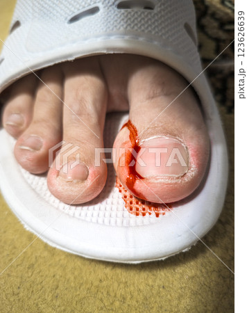 bleeding toe caused by a torn hangnail 123626639