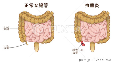 虫垂炎のイラスト appendiciti illustration 123630608