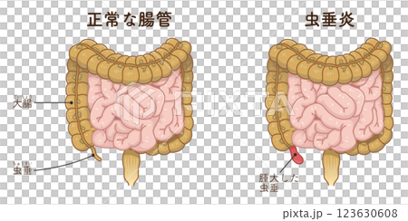 虫垂炎のイラスト appendiciti illustration 123630608