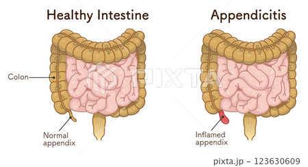 虫垂炎のイラスト appendiciti illustration 虫垂炎のイラスト appendiciti illustration 123630609