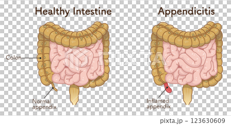 虫垂炎のイラスト appendiciti illustration 虫垂炎のイラスト appendiciti illustration 123630609