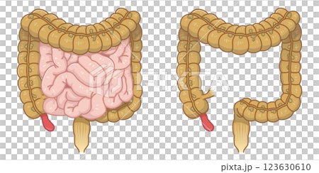 appendicitis illustration appendicitis illustration 123630610