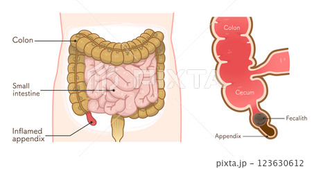 虫垂炎のイラスト appendiciti illustration 虫垂炎のイラスト appendiciti illustration 123630612