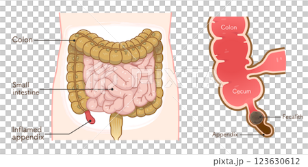 虫垂炎のイラスト appendiciti illustration 虫垂炎のイラスト appendiciti illustration 123630612