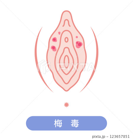 女性外性器の病気　梅毒 123657851