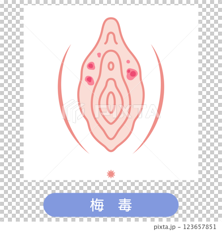 女性外性器の病気　梅毒 123657851