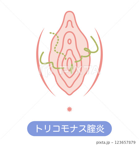 女性外性器の病気 トリコモナス膣炎 女性外性器の病気 トリコモナス膣炎 123657879