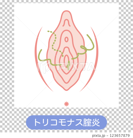 女性外性器の病気 トリコモナス膣炎 女性外性器の病気 トリコモナス膣炎 123657879