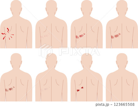 帯状疱疹の症状。正面から見た人間の上半身。 123665508