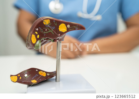 Cirrhosis, Liver cancer, fatty liver, Asian doctor with liver human anatomy model in World Hepatitis Day at hospital. Cirrhosis, Liver cancer, fatty liver, Asian doctor with liver human anatomy model in World Hepatitis Day at hospital. 123665512