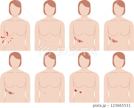 帯状疱疹の症状。正面から見た女性の上半身。 帯状疱疹の症状。正面から見た女性の上半身。 123665531