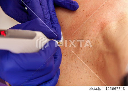 Removal of papillomas on the body 123667748