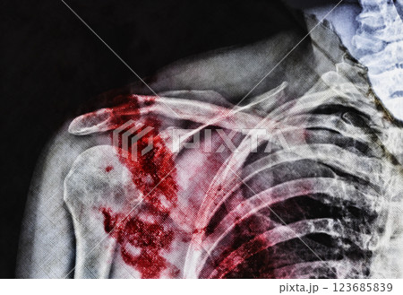 X-ray and stains of blood X-ray and stains of blood 123685839