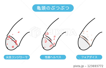 男性生殖器にできたぶつぶつ 性病の種類 男性生殖器にできたぶつぶつ 性病の種類 123693772