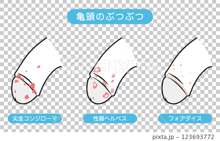 男性生殖器上的腫塊－性傳染病的類型 123693772