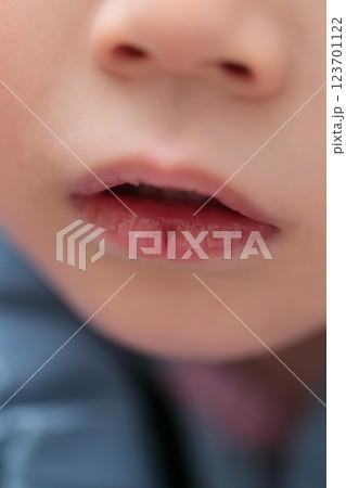 唇が荒れている3歳の女の子 唇が荒れている3歳の女の子 123701122