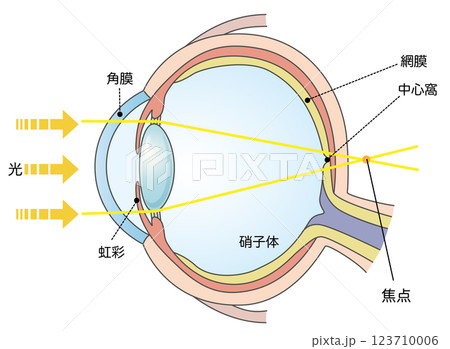 軸性遠視の図解イラスト 123710006