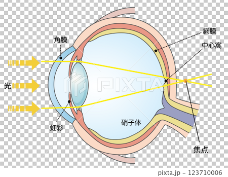 軸性遠視の図解イラスト 123710006