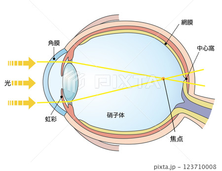 軸性近視の図解イラスト 123710008