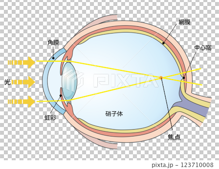 軸性近視の図解イラスト 123710008