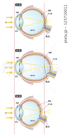正常な眼球と眼軸の長さによる近視、遠視の比較 123710011