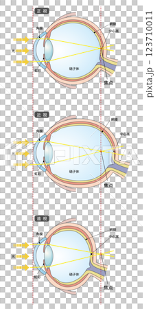 以正常眼球和眼軸長度為依據的近視與遠視的比較 123710011