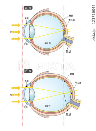 正常な眼球と軸性近視の眼球 123716045