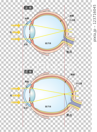 正常な眼球と軸性近視の眼球 123716045