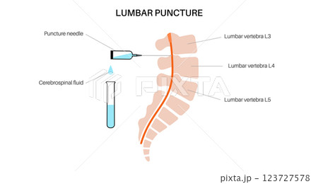 Lumbar puncture spinal tap 123727578