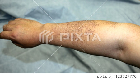 遺伝性皮膚疾患 毛孔性苔癬 遺伝性皮膚疾患 毛孔性苔癬 123727770