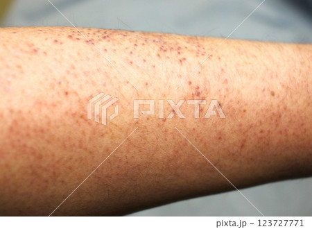 遺伝性皮膚疾患 毛孔性苔癬 遺伝性皮膚疾患 毛孔性苔癬 123727771