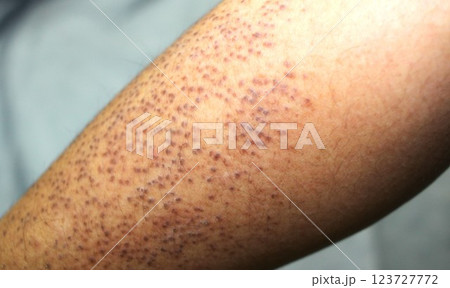 遺伝性皮膚疾患　毛孔性苔癬 123727772