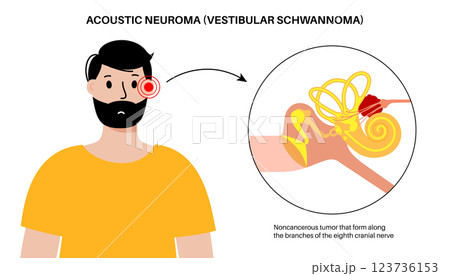 Acoustic neuroma poster 123736153