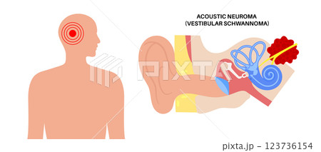 Acoustic neuroma poster 123736154
