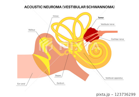 Acoustic neuroma poster 123736299