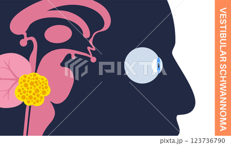Acoustic neuroma poster 123736790