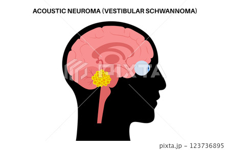 Acoustic neuroma poster 123736895