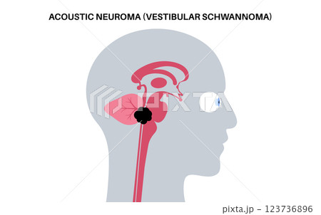 Acoustic neuroma poster 123736896