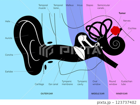 Acoustic neuroma poster 123737482