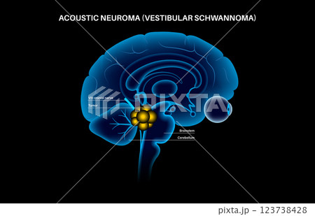Acoustic neuroma poster 123738428