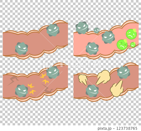 Illustration set of the large intestine with predominantly bad bacteria 123738765